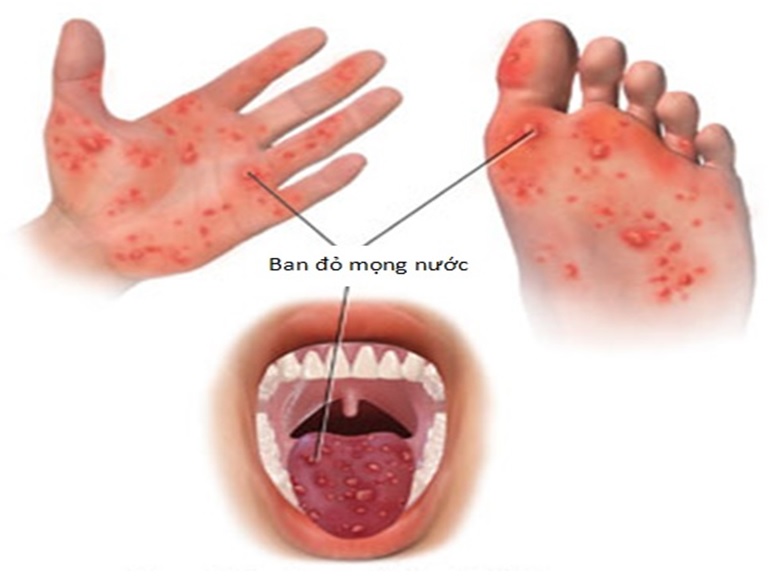 BỆNH TAY CHÂN MIỆNG Ở TRẺ NHỎ